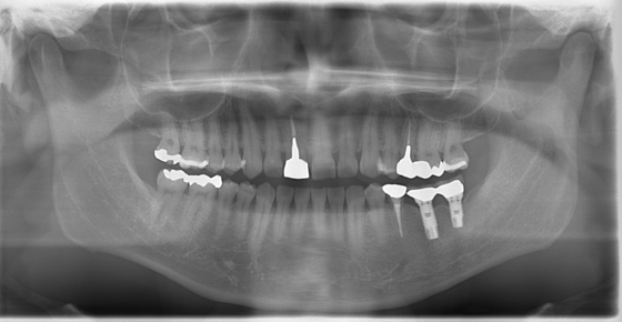 インプラント術後